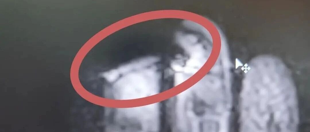 浙江22岁女子摔伤手，做磁共振时片子竟全废，一查问题在手上的猫眼美甲，医生：猫眼美甲暗藏金属成分，干扰磁场还有灼伤风险